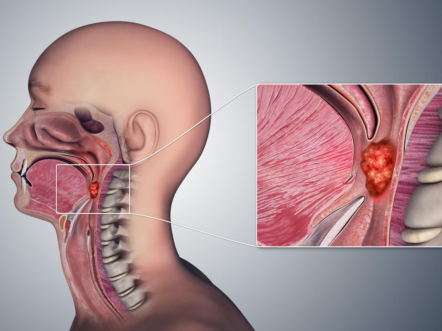 Anal sex now linked to increased rate of throat cancer : Dr Hisham Mehanna