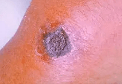 Anthrax Outbreak in Nigeria: Understanding the Disease and Ensuring Safety