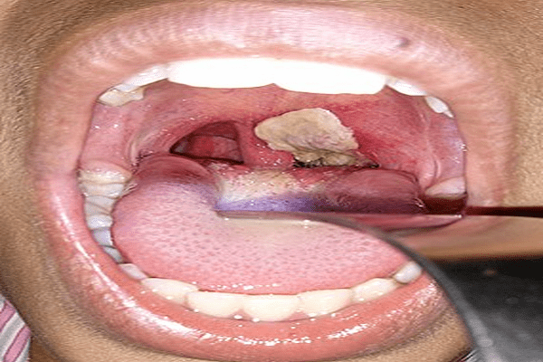 Diphtheria Surge: WHO Identifies Nigeria as High-Risk with Over 4,700 Confirmed Cases