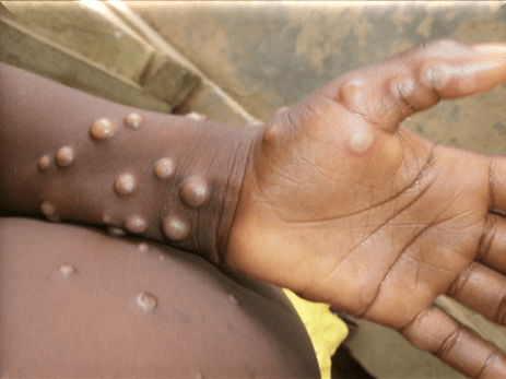 Mpox Outbreak: Africa CDC Issues Continental Health Emergency