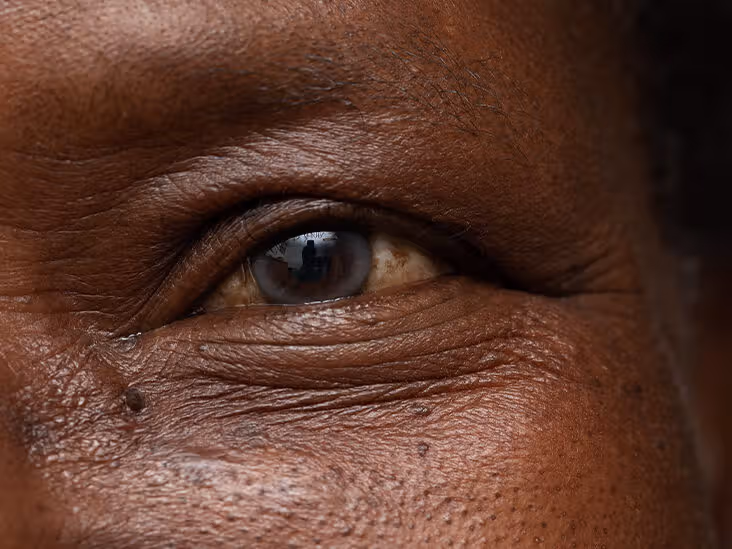 Understanding Old Age Blindness: Causes, Impact, and Preventive Measures