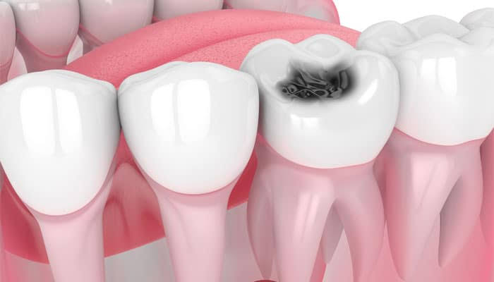 Unveiling Dental Decay: Exploring the Causes and Consequences of Tooth Cavities