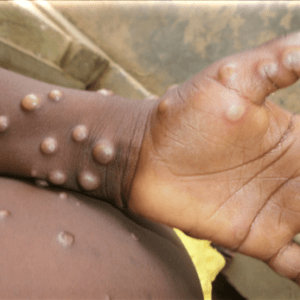 Mpox Africa Health Emergency